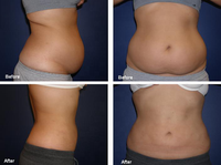 Machines professionnelles de liposuccion au laser 980nm Dispositif de liposuccion Vaser Endolaser lift980 nm Laser