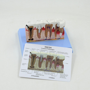 Bệnh lý nha khoa mô hình truyền thông giảng dạy y tế giải phẫu mở rộng bệnh lý trình diễn mô hình Nha khoa Răng bệnh lý - Product Image 2