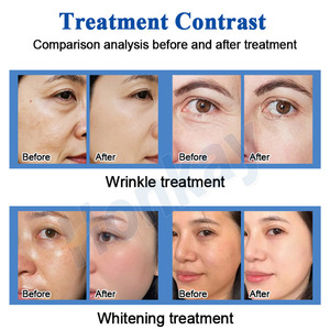 Equipo de Belleza para Spa, Máquina de Jet Peel con Oxígeno para el Cuidado de la Piel, Antiarrugas, OEM ODM - Product Image 5