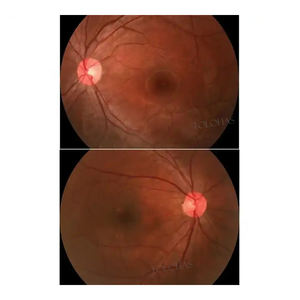 LHV650A oftalmik ekipmanlar Fundus kamera fiyat göz Test makinesi dijital Retin Fundus kamera - Product Image 4