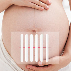 Pansement adhésif Steri-Strip sans couture, pansement à fermeture par traction, pansement chirurgical post-partum. - Product Image 2