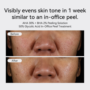 Solution exfoliante <span class=keywords><strong>AHA</strong></span> 30% + <span class=keywords><strong>BHA</strong></span> <span class=keywords><strong>2</strong></span>% OEM/ODM, sérum pour le visage éclaircissant et lissant au rétinol, soin de la peau coréen - Product Image 4