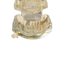 Implant dentaire détachable et modèle de résine de dent pathologique soins bucco-dentaires et démonstration de couronne de pont en PVC pour la science médicale