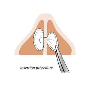 Bouton septal nasal en silicone en gros pour perforations du septum, fermeture non chirurgicale, diamètre 3 cm, épaisseur 1 mm - Product Image 5