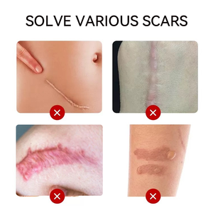 Crème-gel cicatrisante en silicone médical pour anciennes cicatrices sur les jambes – Estompe les cicatrices - Product Image 6