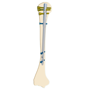 Implant Ortopedi Paduan Titanium Humerus Multidimensional Locking <span class=keywords><strong>Intramedullary</strong></span> Nail Kelas III Bersertifikat CE Ortopedi - Product Image 3