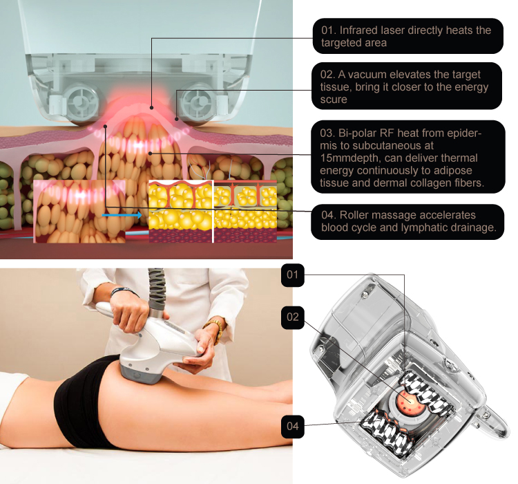 800w 2mhz Rf Body Sculpting Machine Cellulite Reduction Vacuum Shape Machine