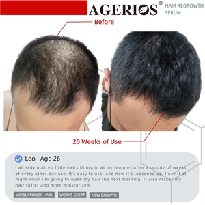 <span class=keywords><strong>Spray</strong></span> Acelerador del Crecimiento del Cabello para Cuero Cabelludo Sensible, <span class=keywords><strong>Bloqueador</strong></span> de DHT con Aminoácidos, Fortalece los Folículos, Agrega Volumen, Apoya el Crecimiento Natural del Cabello - Product Image 5