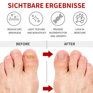 Traitement <span class=keywords><strong>antifongique</strong></span> pour les ongles Ximonth, crème de soin des ongles <span class=keywords><strong>antifongique</strong></span>, 30g - Product Image 5