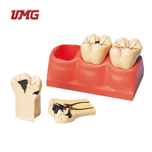 Modelo educativo de ciencia médica, modelo de desmontaje de caries de tamaño 4 veces - Product Image 2