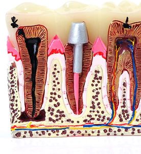 Dentiste utiliser la science médicale dents humaines résine matériel modèle de pathologie dentaire modèle complet de carie dentaire - Product Image 4