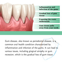 Gouttes de soulagement des gencives South Moon, gencives enflammées, gencives hyperplasiques, saignement des gencives, traitement de la récession gingivale, nettoyage buccal, gouttes réparatrices gingivales