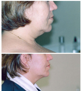 جهاز جراحة التجميل بالليزر لشفط الشحوم بفايزر 1470 نانومتر جهاز شد الوجه بالألياف - Product Image 6