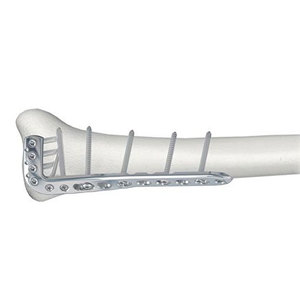 Plaque de blocage tibiale proximale distale médiale latérale manuelle en titane et acier inoxydable avec trous orthopédiques pour implants osseux distal médial - Product Image 5