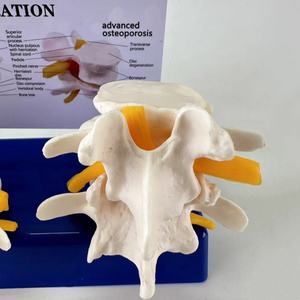 แบบจำลองการบีบอัดหมอนรองกระดูกที่แตกหักแบบสี่ขั้นตอน ตั้งแต่สุขภาพดีไปจนถึงภาวะหมอนรองกระดูกที่แตกหัก - Product Image 5