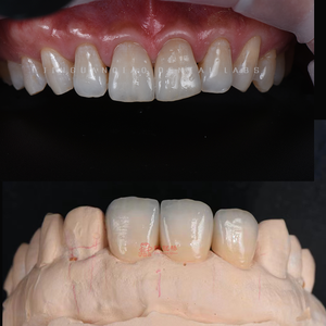 Implantes personalizados Solución de reemplazo dental Implantes dentales con el cuidado adecuado - Product Image 3