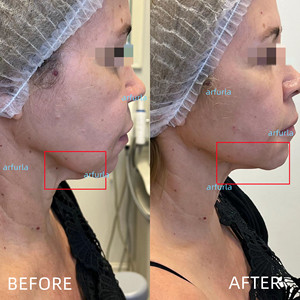 الألياف البصرية Arfurla 3 أمتار 980 نانومتر فيبرا أوبتيكا ليزر 1470 نانومتر ملحقات الألياف البصرية العارية 400um 600um SMA905 - Product Image 5