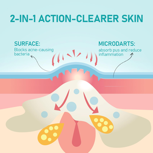 Patchs anti-acné hydrocolloïdes à micro-aiguilles à marque privée avec acide hyaluronique - Product Image 2