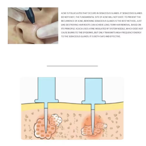 Máquina de Terapia <span class=keywords><strong>Indiba</strong></span> de 448KHz para Reafirmar la Piel, Calentamiento Profundo, Relajación Muscular, Salud y Bienestar - Product Image 6