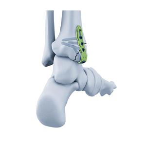 Pelat Pengunci Kait Medial Tibia Distal Titanium |   Implan Medis Ortopedi untuk Fiksasi Fraktur Berat Langsung dari Pabrik - Product Image 3