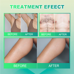 Mesin penghilang rambut elektrolisis, alat penghilang rambut elektrik Ultra cepat portabel <span class=keywords><strong>2026</strong></span> untuk rambut putih - Product Image 5