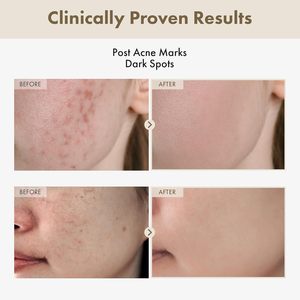 Alta calidad 10% niacinamida 4% TXA suero para la cara cuidado de la piel coreano eliminación de manchas oscuras brillo tono de piel blanqueamiento antienvejecimiento - Product Image 5