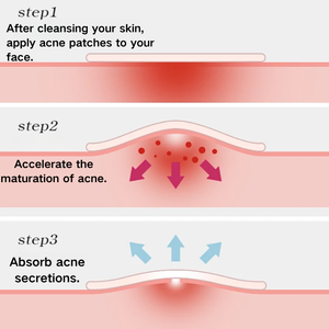 Vente en gros d'usine, patchs d'acné hydrocolloïdes personnalisés et colorés, imperméables, résistants à la <span class=keywords><strong>transpiration</strong></span>, biologiques, végétaliens, <span class=keywords><strong>traitement</strong></span> localisé pour le visage - Product Image 5