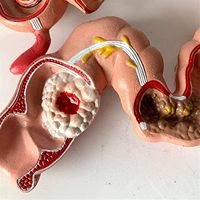 Modèle de maladie du côlon et du rectum humain KyrenMed, modèle pathologique de l'intestin grêle