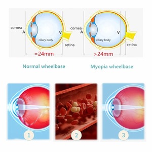 Pseudo myopie Behandlung Vision Enhancement Device Augen entzündung kontrolle Myopia Management Massage gerät - Product Image 6