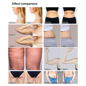 Nueva Máquina de Endermología para Eliminar Arrugas, Moldear el Cuerpo y Adelgazar, Máquina Anticelulitis - Product Image 5