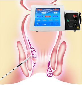 2025 gran oferta máquina de tratamiento láser de Cirugía de proctología 980nm + 1470nm dispositivo de tratamiento de fístula Anal de corte de hemorroides - Product Image 1