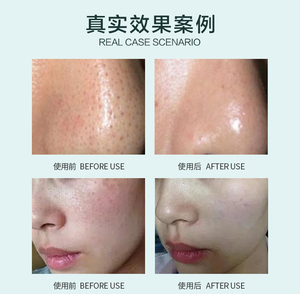Máquina Facial 9 en 1 de Microdermoabrasión Hydra con Oxígeno y 9 Manijas para Rejuvenecimiento, Reafirmación y Blanqueamiento de la Piel (Usado) - Product Image 6