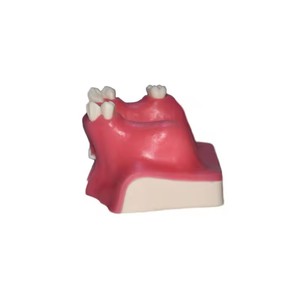 Modèle de communication médecin-patient pour l'implantation dentaire, aide pédagogique orale de classe I pour le lifting du sinus maxillaire, dents manquantes - Product Image 4