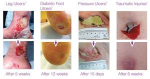 Silicel Hony YAFHO CMC Espuma de Hidrofibra Apósito de silicona - Product Image 3