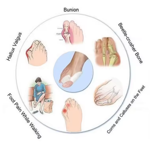 Séparateur d'<span class=keywords><strong>orteils</strong></span> en gel de silicone médical de qualité supérieure, correcteur orthopédique <span class=keywords><strong>pour</strong></span> soulager la douleur des <span class=keywords><strong>orteils</strong></span> - Product Image 5