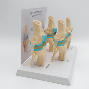 Modelo Anatómico de <span class=keywords><strong>Esqueleto</strong></span> <span class=keywords><strong>Humano</strong></span> de Tamaño Real, Modelo de Articulación de <span class=keywords><strong>Rodilla</strong></span> Enferma en 4 Etapas para Enseñanza - Product Image 5