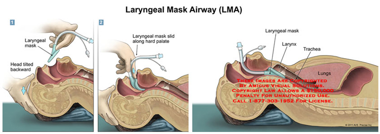 ce和iso fda高品质一次性硅胶喉罩气道 - buy silicone laryngeal