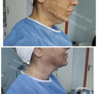 Équipement de suppression de graisse au laser Lipo haute puissance 980 nm 60 W, laser diode, liposuccion, endolaser, lifting