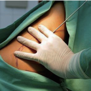    Máquina de Liposucción <span class=keywords><strong>Vaser</strong></span> de 980nm para Adelgazamiento, Máquina de Lipólisis Láser de 1470nm para Eliminación de Grasa, Máquina de Lipo Láser - Product Image 3