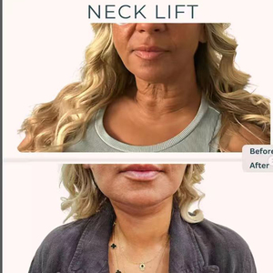 Lipólisis Láser, Dispositivo de Liposucción con Diodo Láser de Doble Onda de 47w <span class=keywords><strong>980</strong></span>+1470nm, Máquina de Lifting Facial Endoláser - Product Image 6