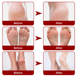 Solución Exfoliante de Alta Calidad con 30% AHA y 2% BHA para Diversos Problemas de Pies, Mascarilla para el Cuidado de los Pies - Product Image 4
