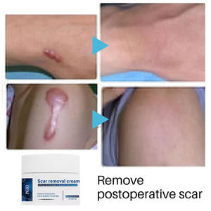 Crème de traitement d'élimination des cicatrices à base de plantes à base de plantes pour les cicatrices d'acné du visage et du corps-Tous les types de peau Utilisation féminine - Product Image 3