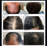 Huile d'argan et romarin naturel de marque privée avec logo personnalisé Sérum de traitement capillaire anti-chute Huile de repousse des cheveux à la biotine