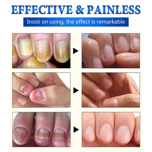 ETRUN ALISA Marque privée <span class=keywords><strong>Huile</strong></span> anti-paronychie endommagée et décoloration <span class=keywords><strong>Huile</strong></span> de soulagement des champignons pour les ongles d'orteils - Product Image 6