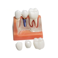 Modèle d'implant dentaire pour la démonstration patiente Modèle de couronne et de pont d'implant dentaire