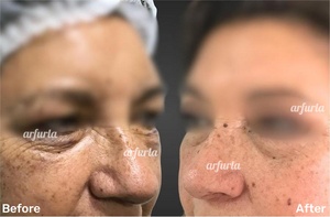 Manípulo de Lipólisis Arfurla, Accesorio Lipo Endoláser para Láser de Diodo de 980nm y 1470nm, 5 Cánulas, CE - Product Image 4
