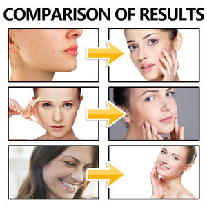 Sérum de soins de la peau de haute qualité oem soins de la peau sérum à l'acide hyaluronique sérum anti-acné à l'acide hydro salicylique organique - Product Image 5