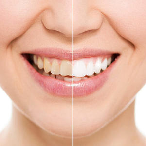 โอพาเลสเซนซ์ พีเอฟ มิ้นท์ 35% เจลฟอกสีฟัน - ซีพี เมนทอล สมุนไพร วิตามินซี แบบหลอดฉีดพร้อมถาดสำหรับใช้ที่บ้าน |   การดูแลทันตกรรมสำหรับผู้ใหญ่ - Product Image 5