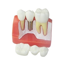 Dentiste dentaire Modèle de Dents De Démonstration D'implant L'analyse Couronne Pont bon