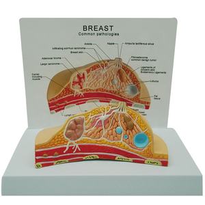 Modelo Anatômico de Doença de Lesão em Patologia Mamária - Product Image 1